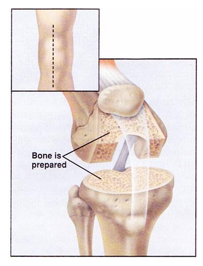 knee replacement